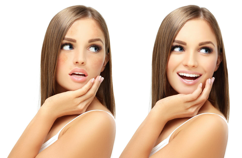 What is the Difference Between Hyperpigmentation and Melasma?